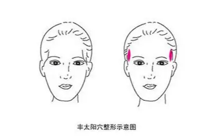 太阳穴自体脂肪填充多少钱？这4点99%的人都不知道~