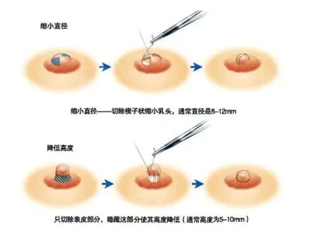 缩胸手术有哪些方法？一起来看一下