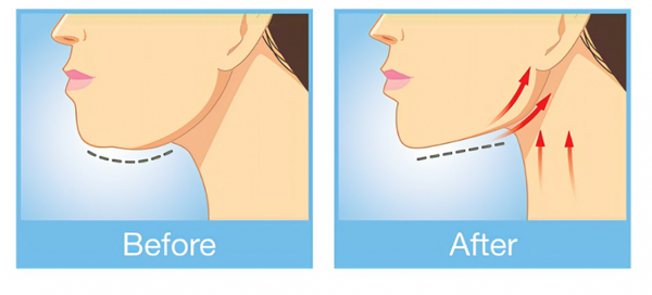 出现双下巴的原因以及去除双下巴可以采取的4种方法图片
