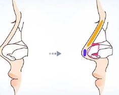 鼻小柱延长能保持多久手术的过程图片